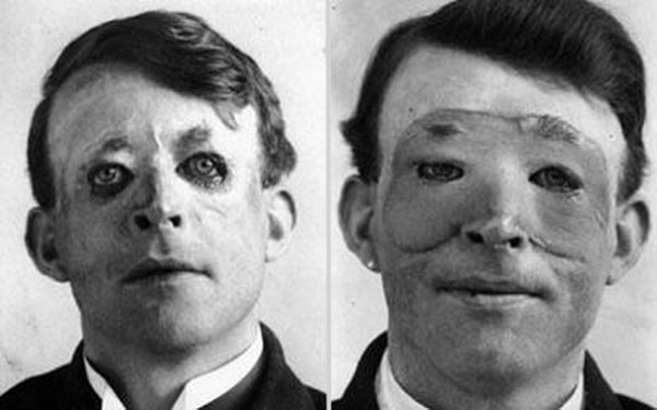 1917 : Une des premières transplantation de peau